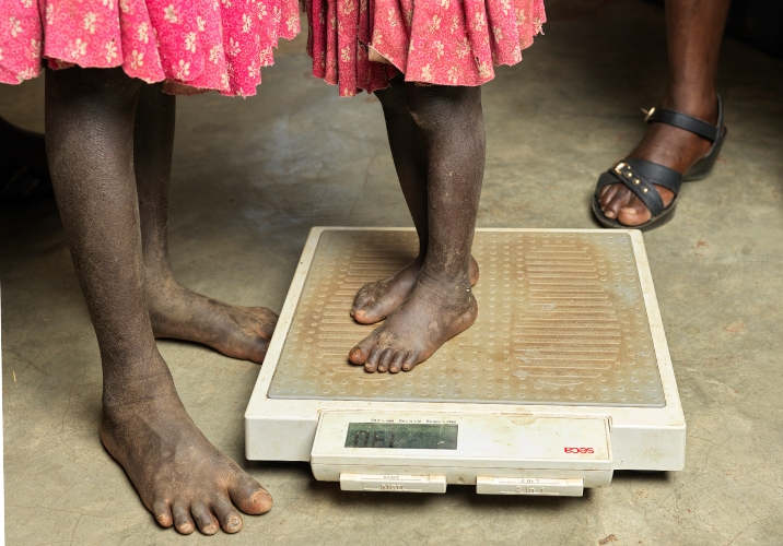 Child stood on scaled, getting weighed on scaled for malnutrition.